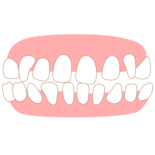 すきっ歯のことでお悩みの方