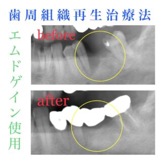 ＶＩＴＡイージーシェードＶ導入しました！！ | 台東区御徒町の歯医者「ビーノ御徒町歯科クリニック」です。